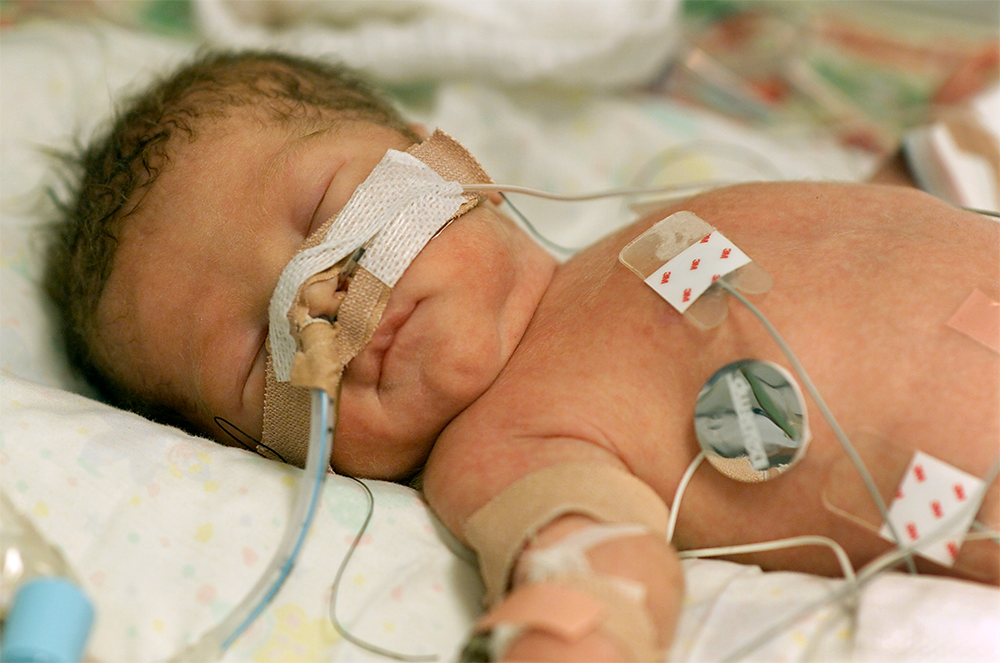 An opioid exposed infant.
